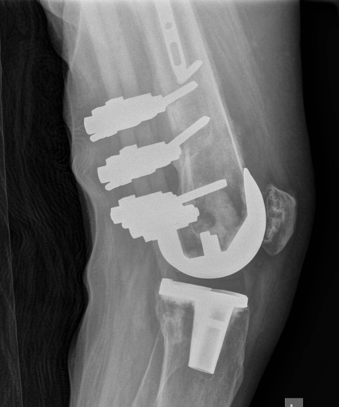 Infected Femoral Nail4